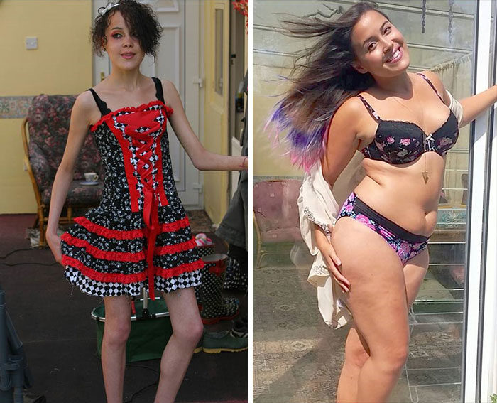 anoressia prima e dopo anoressia prima e dopo