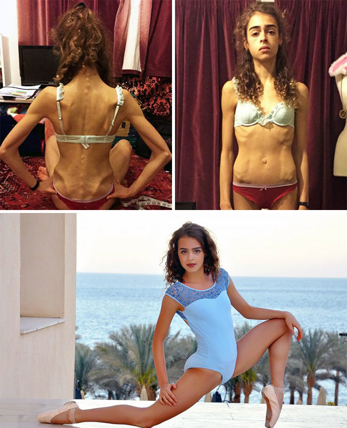 Anoressia immagini prima e dopo guarigione