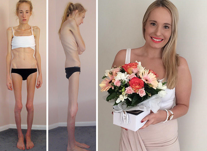 Anoressia immagini prima e dopo guarigione