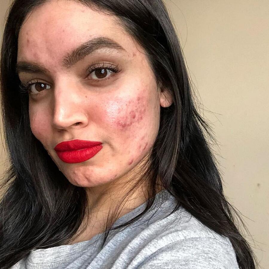 Beauty Blogger Rifiutata Da L'Oreal Perché Ha Acne Kadeeja Khan